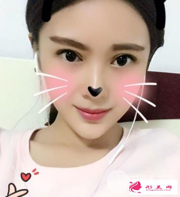 成都劉輔容雙眼皮修復(fù)到底怎么樣？和大家分享一波劉輔容眼修復(fù)案例