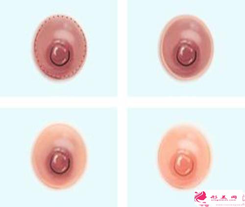 乳暈縮小手術后遺癥_乳暈縮小手術后會留疤嗎？
