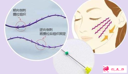 臉部做了線雕多久沒有緊繃感