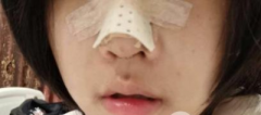 硅膠隆鼻案例|從18歲就想換鼻子，做完竟然有點(diǎn)韓系~