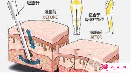 大腿吸脂減肥部位