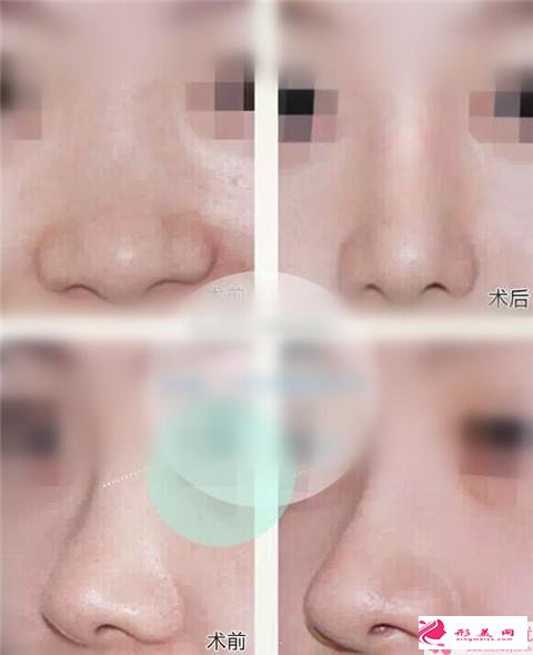 哪些人適合鼻翼縮小手術(shù)