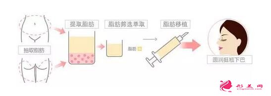 墊下巴多少錢