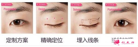 韓式三點雙眼皮手術(shù)示意圖
