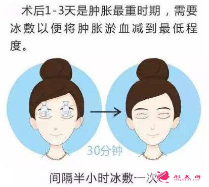 涮牛宮炎平手術(shù)后,48小時內(nèi)可以用冰袋局部性冰敷