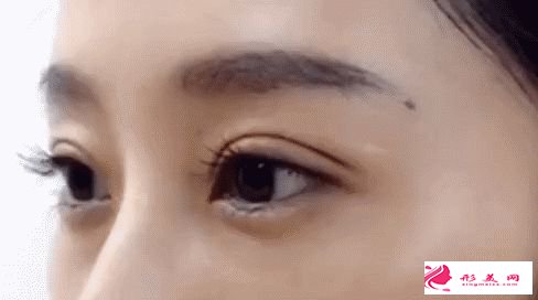 全切雙眼皮老了會消失嗎