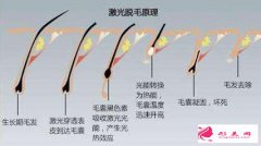 激光脫毛有色素沉著怎么辦