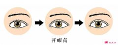 什么人適合開眼角