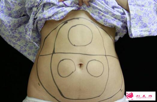 腹部吸脂后多久能懷孕