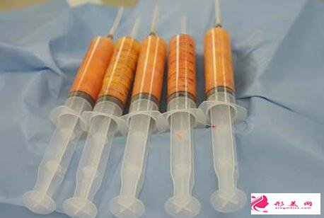 自體脂肪填充臉部后多久可以洗臉
