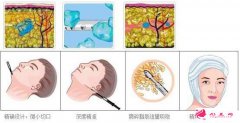 面部吸脂能減多少脂肪？