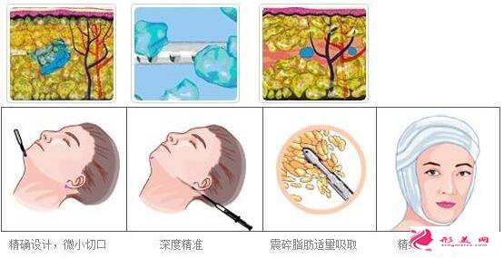 面部吸脂能減多少脂肪