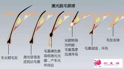 激光脫毛后為什么還會再長