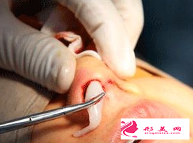隆鼻假體取出會有什么癥狀