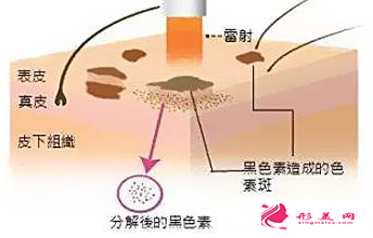 激光祛黃褐斑后會(huì)反彈嗎
