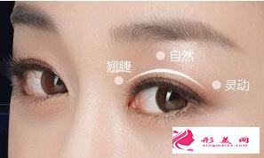 切開(kāi)雙眼皮術(shù)前術(shù)后要注意什么