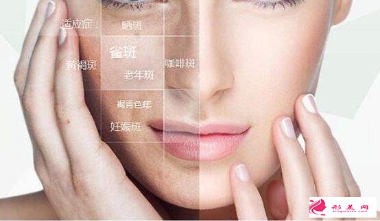 激光祛斑可能存在的后遺癥