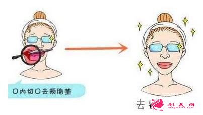 去頰脂墊價(jià)格
