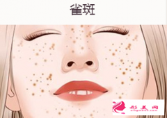 激光祛雀斑一次能做好嗎？