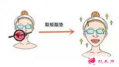 去頰脂墊效果多久出來？需要注意什么？