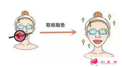 去頰脂墊效果