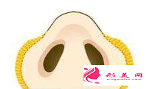 鼻翼縮小手術(shù)后多久才可以化妝