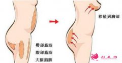 自體脂肪隆胸后多久才能哺乳