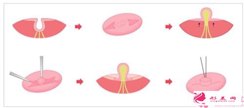 乳頭縮小手術(shù)失敗后怎么辦_解決乳頭縮小手術(shù)失敗的方法