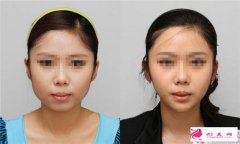 吸脂瘦臉的益處有哪些呢？