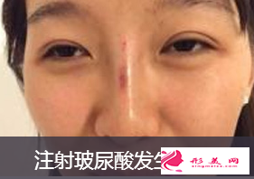 注射隆鼻取出后還能隆鼻嗎