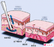 抽脂手術(shù)減肥多少錢？