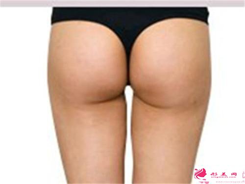 豐臀的費用受何種所改變？應該是多少元？