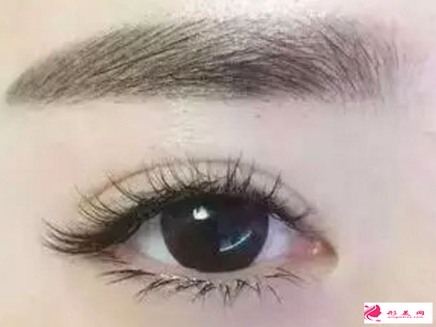 埋線雙眼皮有什么缺陷嗎