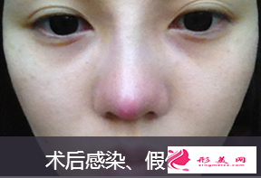 假體隆鼻感染要怎么處理