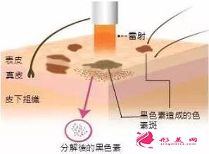 打了玻尿酸還能做激光祛斑嗎