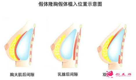 隆胸假體放置的位置