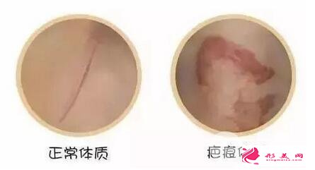 疤痕體質(zhì)