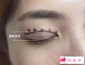 做埋線雙眼皮需要麻醉嗎