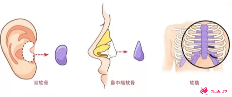自體軟骨隆鼻后能抽煙嗎