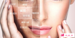 激光祛斑都會有結(jié)痂嗎？