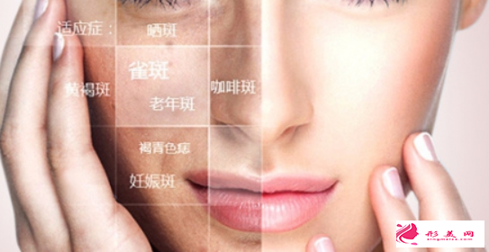 激光祛斑都會有結(jié)痂嗎