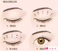 眼皮松弛也能做埋線雙眼皮嗎？