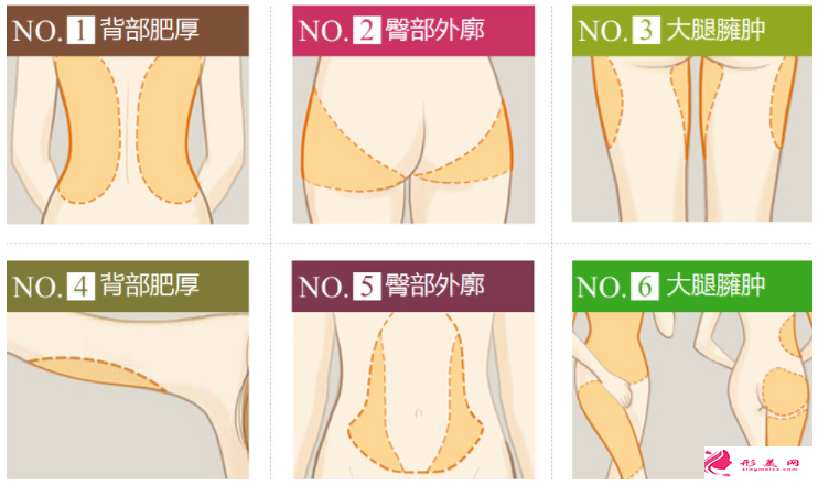 吸脂減肥常見的后遺癥