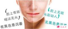 激光祛雀斑要做多少次療程？