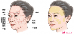自體脂肪填充面部會失敗嗎？