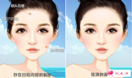自體脂肪填充面部會失敗嗎