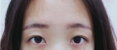 外切去眼袋手術(shù)效果，會留疤嗎？