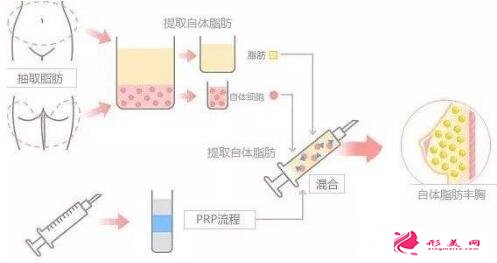 抽脂豐胸的手術(shù)原理是什么?