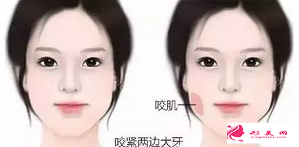 瘦臉針費(fèi)用受哪些因素影響