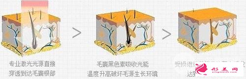 小腿激光脫毛的價(jià)格多少錢？恢復(fù)時(shí)間是多久？